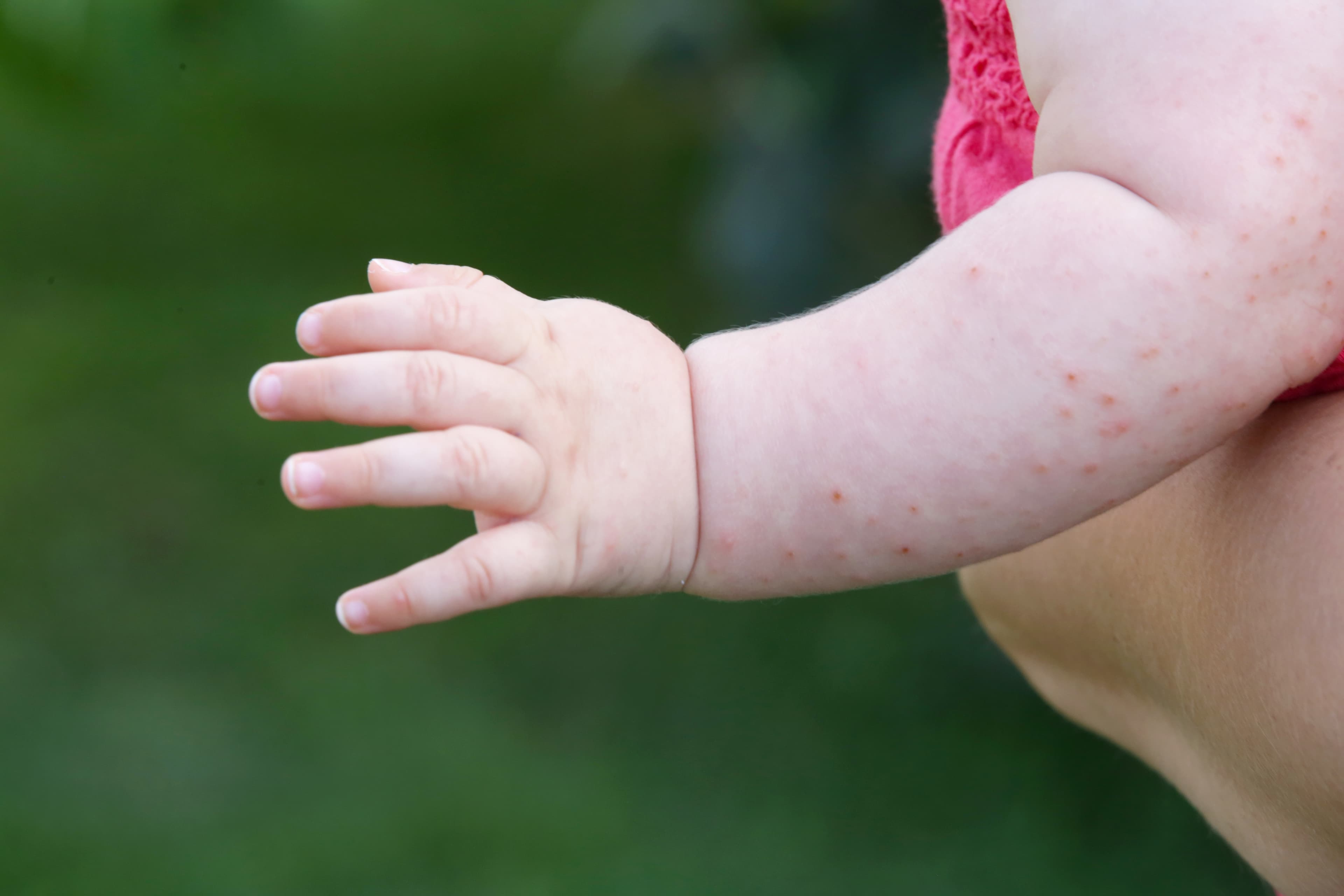 Baby rash caused by fever, insect bite, skin allergy or heat reaction